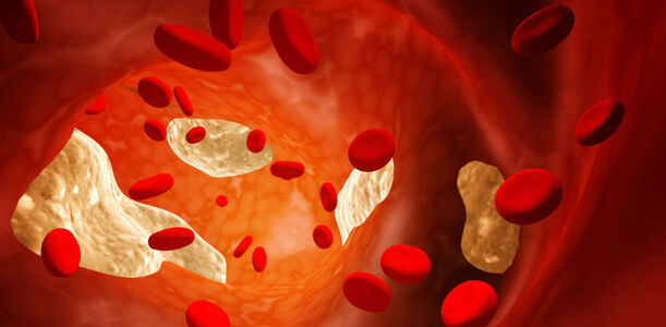 Bild zu Lipidstoffwechsel - Neue lipidmodifizierende Therapie-Optionen