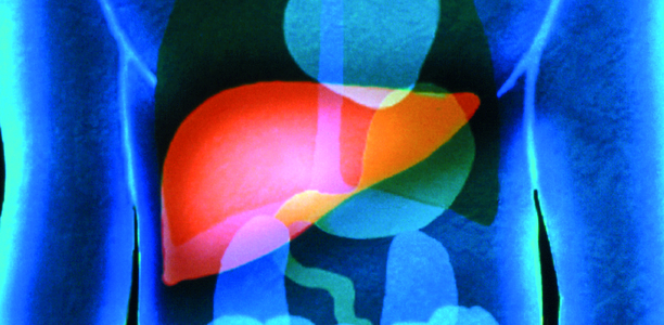 Bild zu NAFLD - Fettleber auch ohne Alkohol?