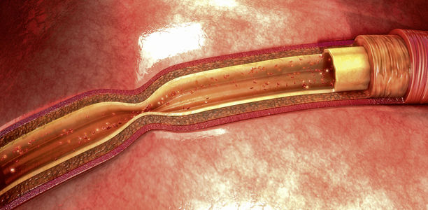 Bild zu Schwerpunkt: Diabetes und pAVK - Möglichkeiten der Gefäßchirurgie