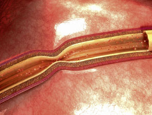 Bild zu Schwerpunkt: Diabetes und pAVK - Möglichkeiten der Gefäßchirurgie