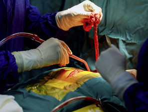 Bild zu Standardrevaskularisation bei Diabetikern - Bypass-Operation ist nicht mehr Standard­revaskularisation