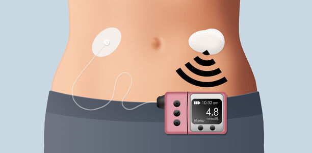 Bild zu Schwerpunkt: „CGM und Ernährung“ - Besonderheiten bei CGM- Schulung