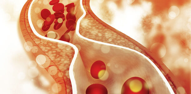 Bild zu Alirocumab - Sanofi plant Wiedereinführung des PCSK9-Inhibitors in Deutschland