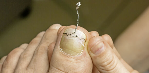 Bild zu Erstattung - Breiterer Spangeneinsatz