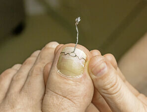 Bild zu Erstattung - Breiterer Spangeneinsatz