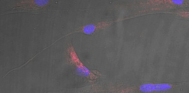 Bild zu Adipositas - Fettes Stresssignal