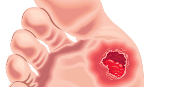 Bild zu Fortbildung - Diabetisches Fußsyndrom – Wundmanagement
