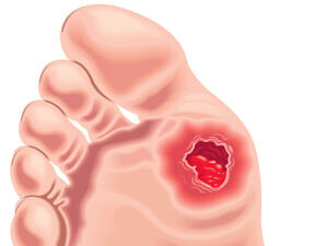 Bild zu Fortbildung - DFS: Wundmanagement