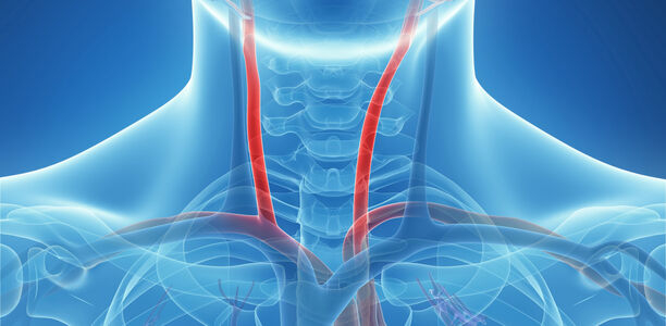 Bild zu Carotid intima-media thickness - Correlation between serum miR-23b and miR-34a expression and carotid intima-media thickness in patients with type 2 diabetes mellitus
