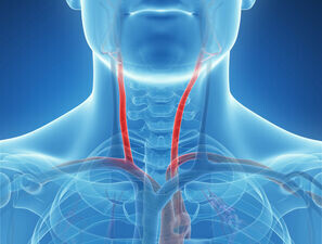 Bild zu Carotid intima-media thickness - Correlation: microRNA levels and carotic intima-media thickness