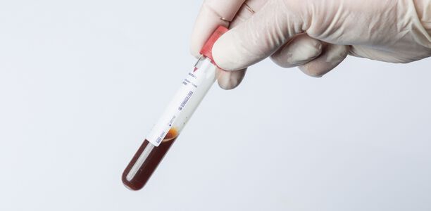 Bild zu Glukosemessung - Adäquate prä-analytische Handhabung von Proben zur Glukosemessung: Klärung bei einem klinisch relevanten Thema