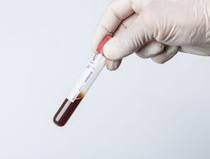 Bild zu Glukosemessung - Adäquate prä-analytische Handhabung von Proben