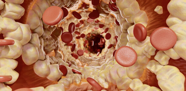 Bild zu Begleit- und Folgeerkrankungen -  Fettstoffwechselstörungen