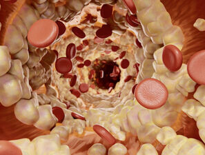 Bild zu Begleit- und Folgeerkrankungen -  Fettstoffwechselstörungen