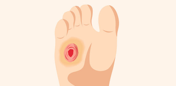 Bild zu BVKD - DIE Diabetes-Kliniken - Ursachen des Diabetischen Fußsyndroms

