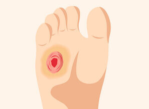 Bild zu BVKD - DIE Diabetes-Kliniken - Ursachen des DFS