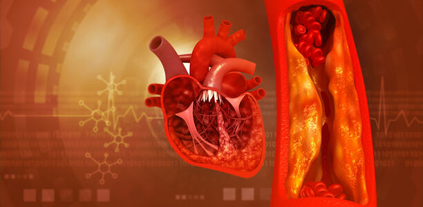 Bild zu ANZEIGE - Atherosklerose und Gefäßschutz bei Typ-2-Diabetes