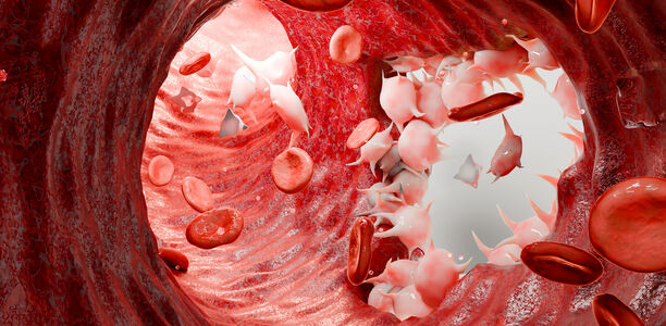 Bild zu Schwerpunkt Blutgerinnungssystem - Pathogenese und Ablauf der Blutgerinnung