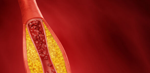 Bild zu Schwerpunkt Blutgerinnungssysteme - Prophylaxe und Therapie bei Gerinnungsstörungen