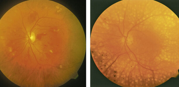 Bild zu BVKD - DIE Diabetes-Kliniken - Diabetische Retinopathie