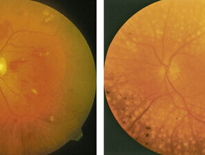 Bild zu BVKD - DIE Diabetes-Kliniken - Diabetische Retinopathie