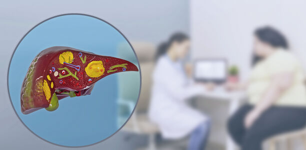Bild zu Schwerpunkt Adipositas - Heterogenität bei Fettlebererkrankung