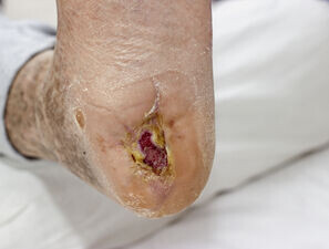 Bild zu BVKD - DIE Diabetes-Kliniken - Postoperative Hilfsmittelversorgung bei DFS