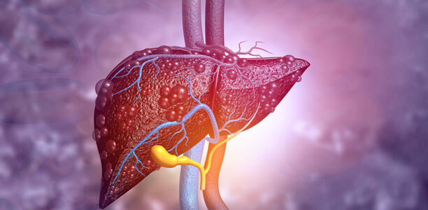 Bild zu Diabetes | Herz | Gefäße - Fettleber ist nicht gleich Fettleber