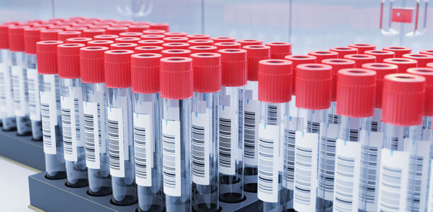 Bild zu Verwenden Sie die empfohlenen Teströhrchen für die Glukosemessung? - Neue Richtlinien für die präanalytische Handhabung in Deutschland
