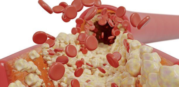 Bild zu Fortbildung - Fettstoffwechselstörungen und Diabetes 