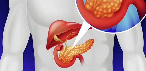 Bild zu BVND - Diabetische Ketoazidosen – Handlungsempfehlung 
